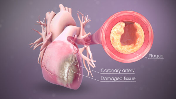 Heart Attack Symptoms, Causes, and Treatment